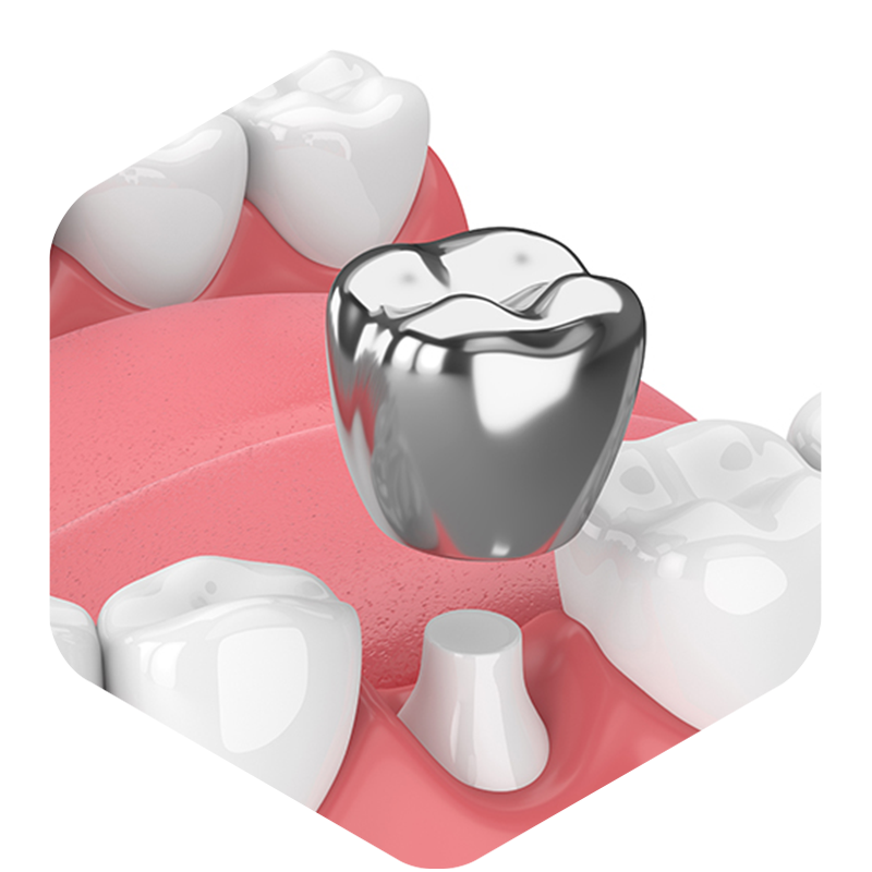 A 3D illustration of a crown being placed.